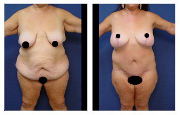 Post Bariatric Body Lift before and after photos showcasing the transformative effects of a tummy tuck procedure.