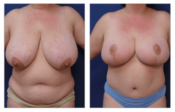 A woman's breasts before and after a breast lift.