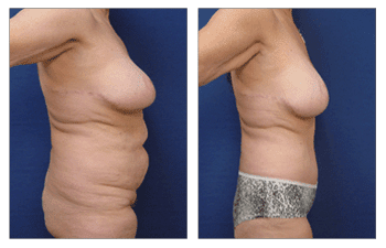 Tummy tuck before and after / Insurance Coverage for Body Lift