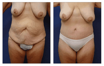 Post-Bariatric Body Lift Beverly Hills