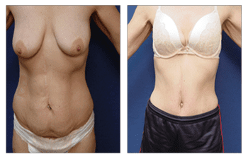 Post Bariatric Body Transformation - Tummy Tuck Before and After