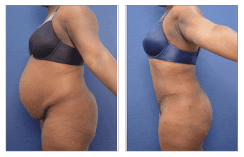 Skin reduction surgery before and after tummy tuck.