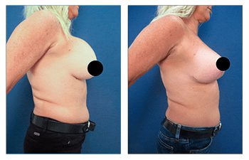 Boob Job to Fix Operated Looking Breasts