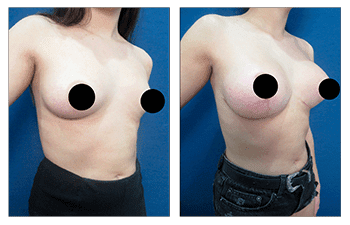 Correcting Breast Asymmetry