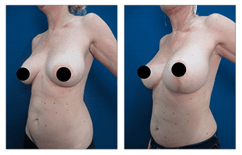 What is a Breast Lift with Implants Over the Muscle?