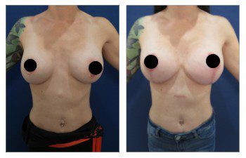 How to Fix Poor Areola Scarring After Breast Lift