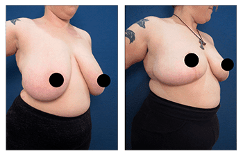 How to Get Insurance Coverage for Breast Reduction