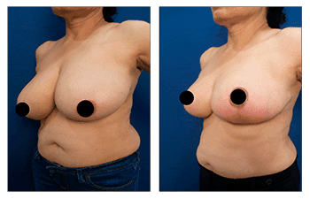 Redness Over Lower Breast Following Breast Lift