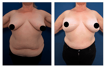 Bilateral Breast Mastectomy and Reconstruction Provides Improved Cosmetic