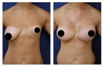 Correcting Congenital Breast Deformity