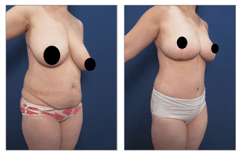 What is a Breast Reduction?