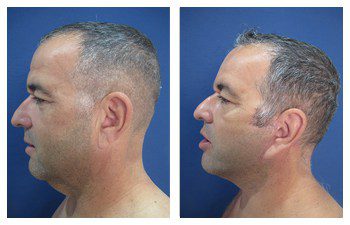 A man's face before and after undergoing a facelift, exploring the transformation and changes brought by the procedure.