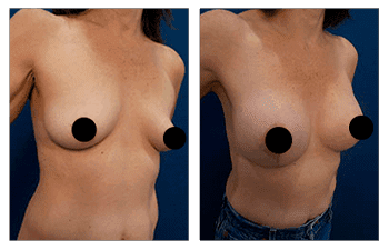 Most Expensive Breast Lift with Implants