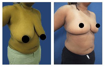 Best Breast Reduction