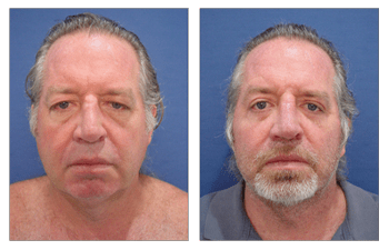 A man with a beard before and after a rejuvenating facelift.