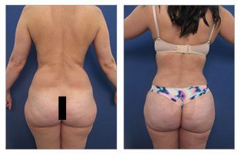 Before and after pictures showcasing a woman's remarkable buttlift transformation.