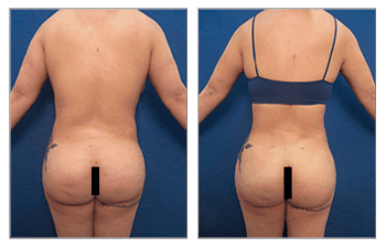 Before and after pictures of a woman's butt following a BBL redo.