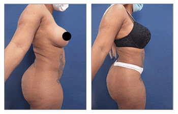 Tummy tuck before and after transformation achieved by skilled BBL Revision Doctors.