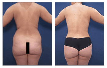 Before and after pictures of a woman's tummy tuck in preparation for a BBL revision.