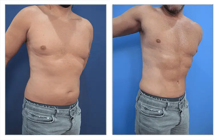 360 Tummy Tuck before and after.