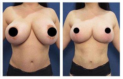 A woman's breasts undergo a remarkable transformation through the best breast lift revision procedure.