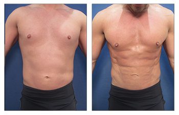 Best male tummy tuck before and after results.