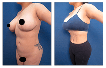 Before and after photos of a woman's breast surgery and how will my butt look like in clothes after BBL.