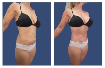 Before and after pictures showcasing a woman's tummy tuck transformation, correcting contour irregularities.