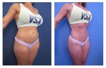 High-Definition Liposuction Cost