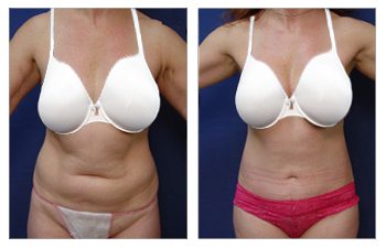 Mini Tummy Tuck Cost