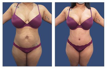 Tummy Tuck After C Section