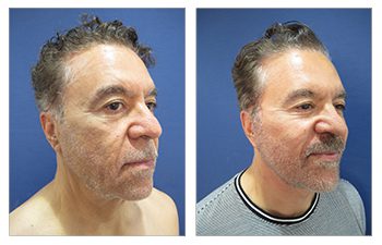 Setting your beard line during male facelift surgery