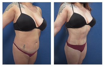 360 Liposuction or Liposuction area-by-area - Which One is Better?