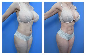 What is Laser Liposuction?