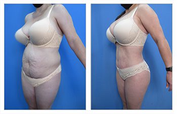 High Definition Body Contouring - Skin Redundancy vs. Skin Elasticity