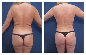 Back Liposuction Before and After