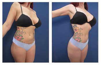 Airsculpt Liposuction vs VASER HD Lipo