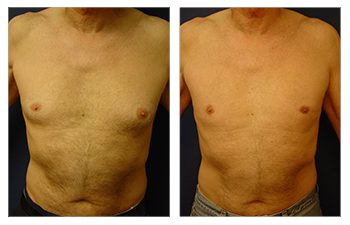 gynecomastia surgery be covered by insurance