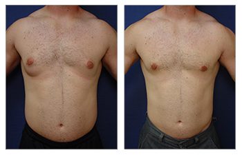 Does gynecomastia surgery reduce nipple size