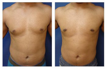 Does Gynecomastia Surgery Leave Scars