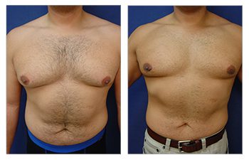 gynecomastia surgery