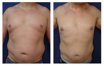 How is Gynecomastia Surgery Performed?