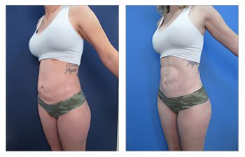 Best Liposuction Surgeon in Los Angeles