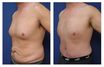 Male Breast Surgery versus Gynecomastia Surgery