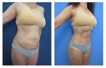 Advanced Liposuction Revision