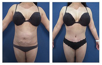 Advances in High Definition Liposuction Revision