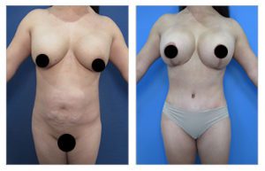 Breast Implant Removal Surgery