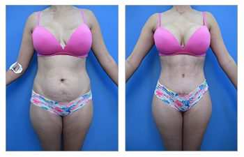 Liposuction with a Tummy Tuck