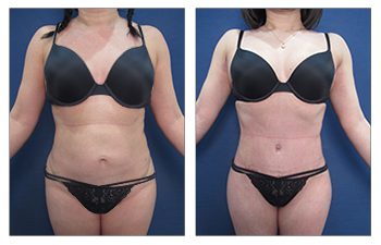 What is Safe Liposuction?