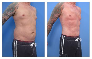 What is VASER Liposuction?